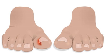 ingrown nail cure